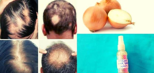 علاج تساقط الشعر بالمنزل